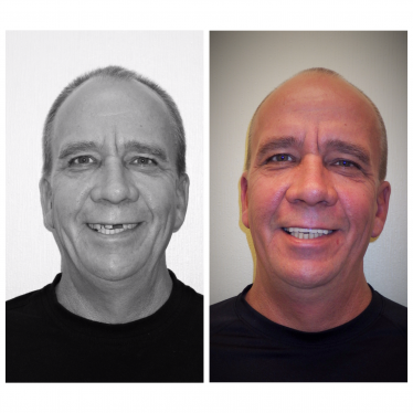 Case 1 before and after cosmetic treatment photos