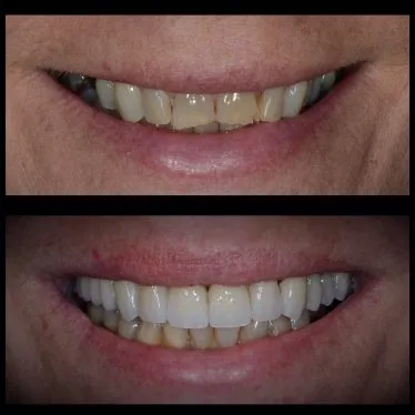 Caes 1 before and after cosmetic treatment up close photos