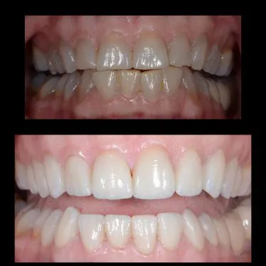 Case 2 before and after cosmetic treatment photos