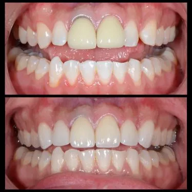 Case 3 before and after cosmetic treatment photos