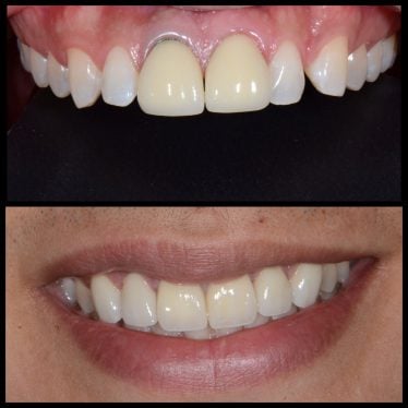 Case 4 before and after cosmetic treatment photos