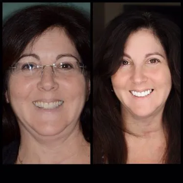Case 4 before and after cosmetic treatment full face photos