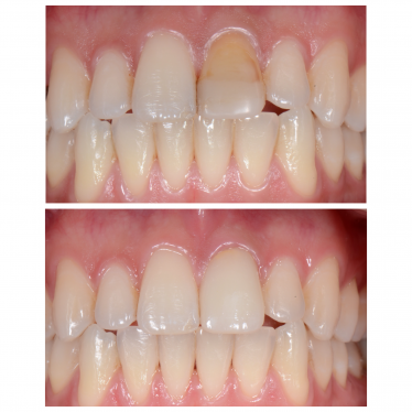 before and after photos - crowns