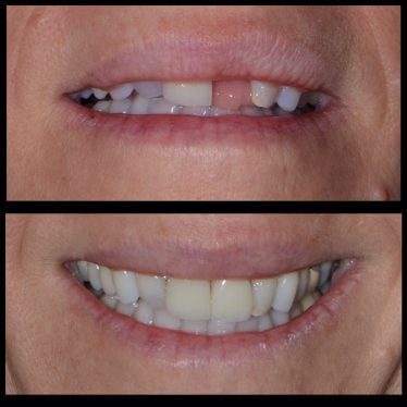 before and after photos - single tooth restorations