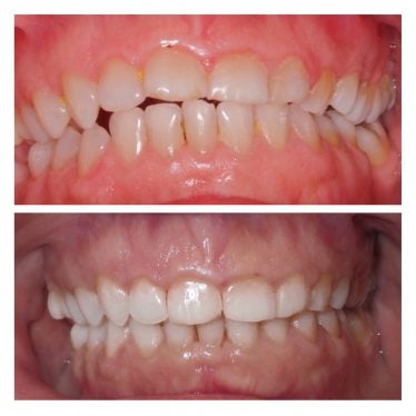 Before and after photos-Invisalign treatment