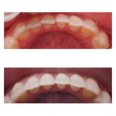 before and after photos - Invisalign