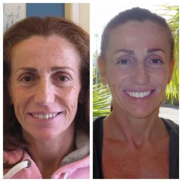 before and after photos - Invisalign