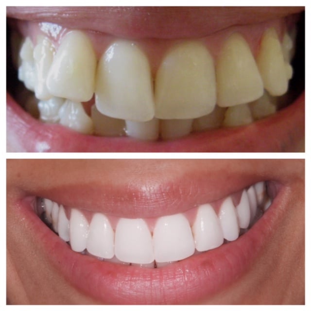 before and after photos - Invisalign