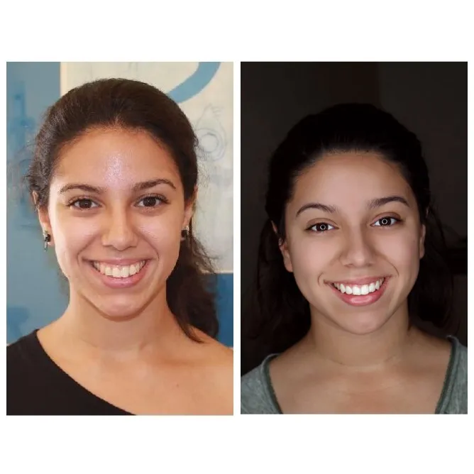 before and after photos - Invisalign
